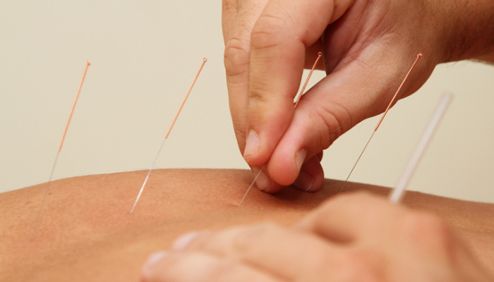 acupuntura